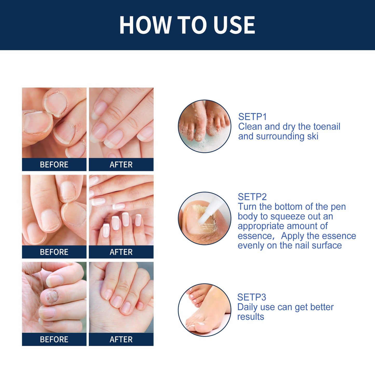 West&Month Nail Repair Relieve Essence Pen, Moisturizing Repair Hand And Foot Inlay Nail Thickening Grey Nail Correction Pen