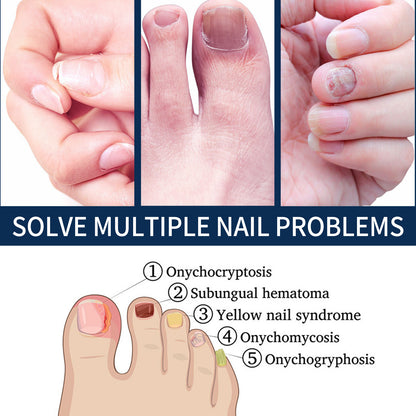 West&Month Nail Repair Relieve Essence Pen, Moisturizing Repair Hand And Foot Inlay Nail Thickening Grey Nail Correction Pen